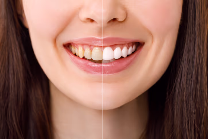 Clear Aligners with Dr. Jeremy Montrose